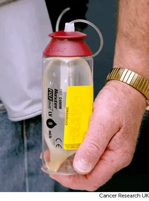 Photograph showing a continuous pressure pump for chemotherapy .