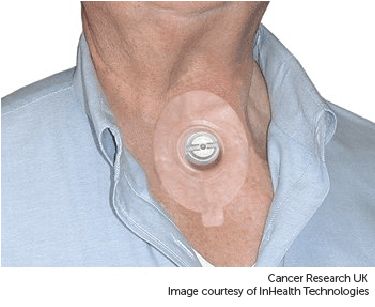 Photograph showing a heat and moisture exchanger (HME).