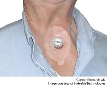 Photograph showing a heat and moisture exchanger (HME).