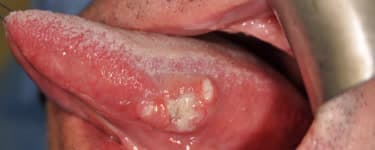 Photo showing T1 tongue squamous cell carcinoma.