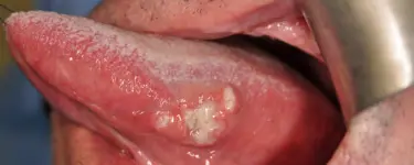 Photo showing T1 tongue squamous cell carcinoma.