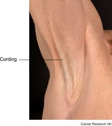 Picture showing cording in the armpit.