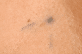 Photograph of radiotherapy tattoo marks.