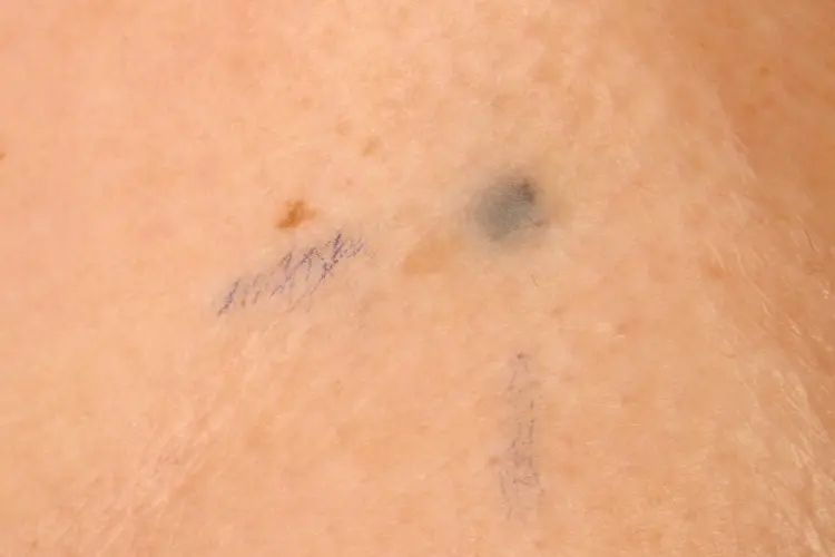 Photograph of radiotherapy tattoo marks.
