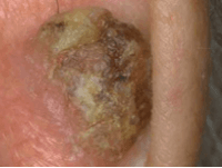 Photograph of squamous cell cancer.