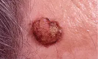 Photograph of squamous cell cancer.