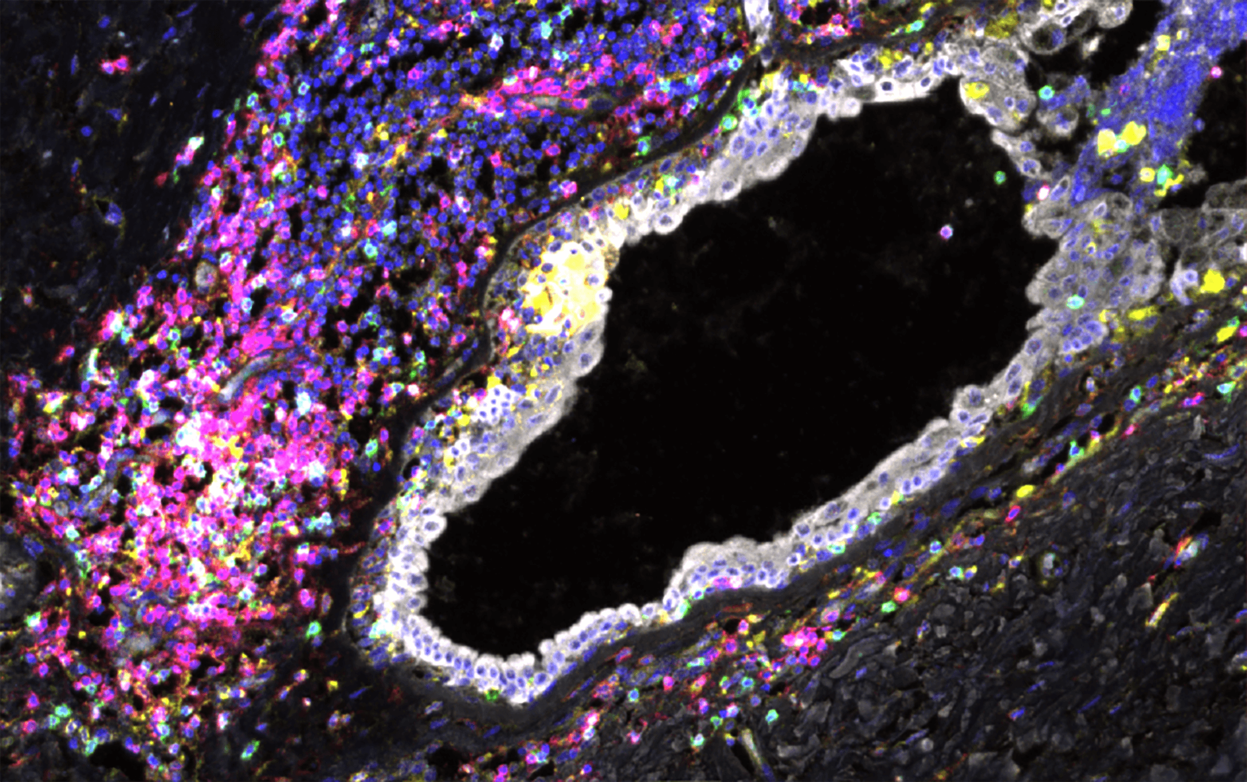 Mapping of breast cancer premalignancy.