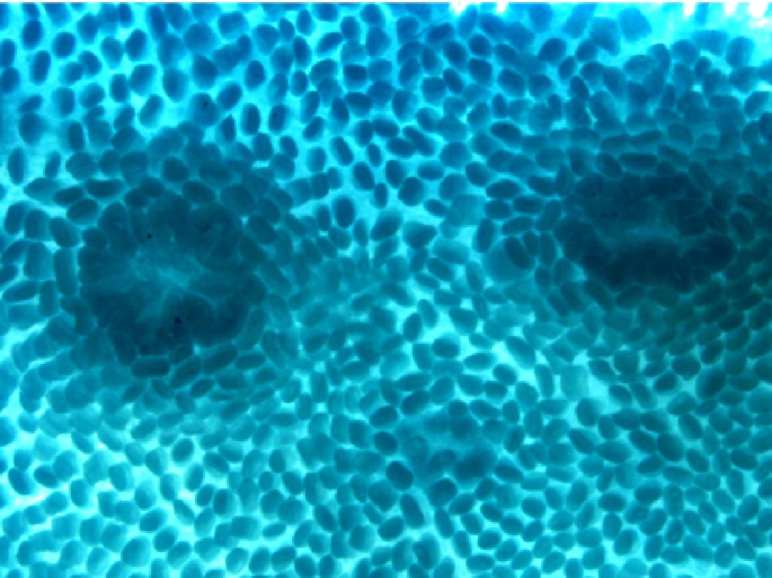 A photo of methyl blue stained whole mount preps of bowel tumours.