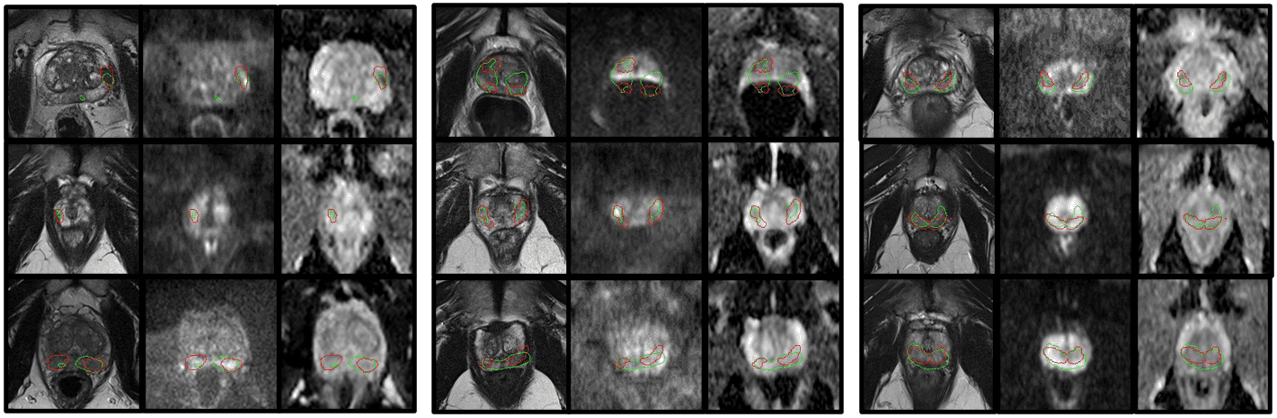 Early prostate cancer detection.