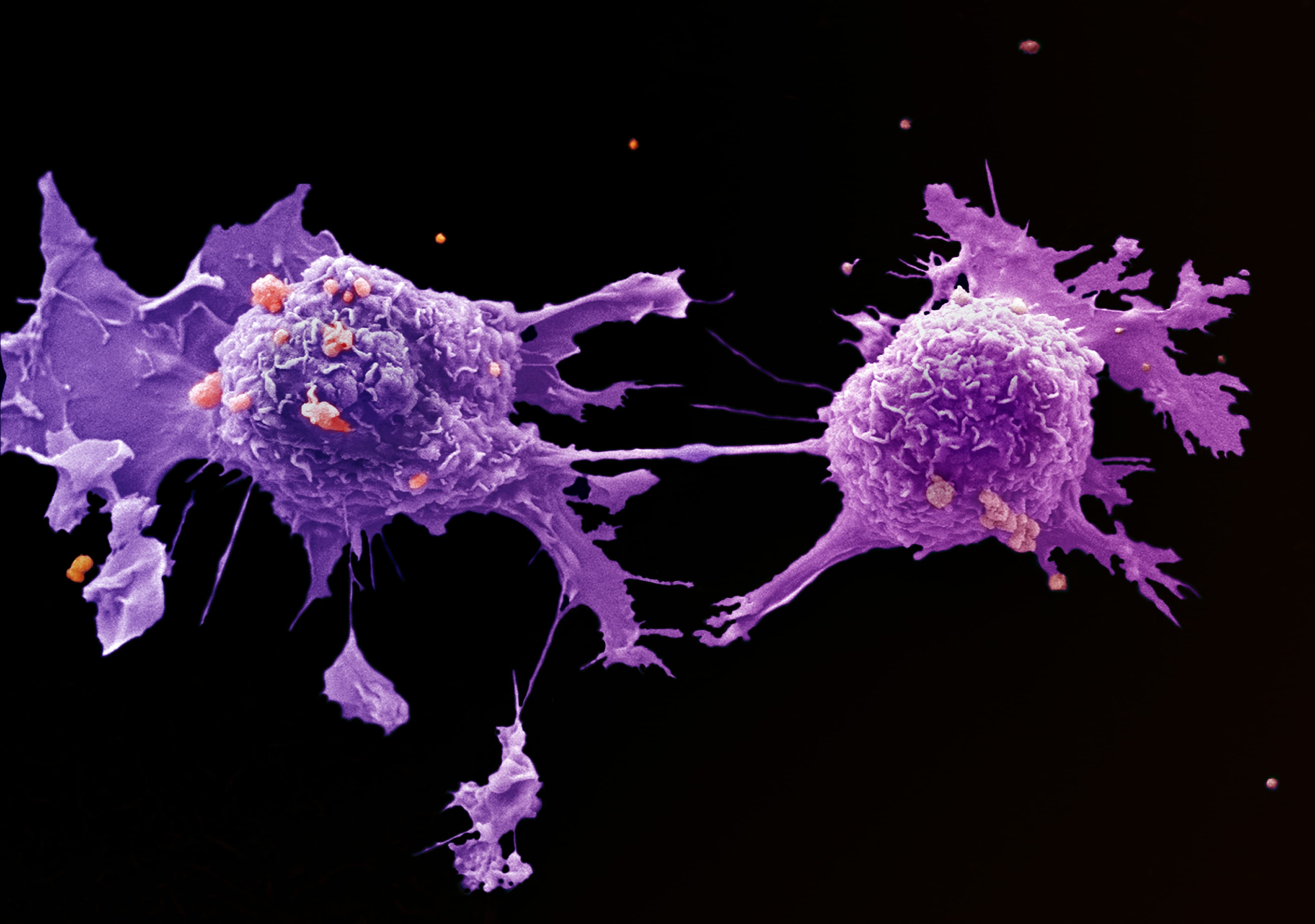Lung cancer cells viewed with an electron microscope.