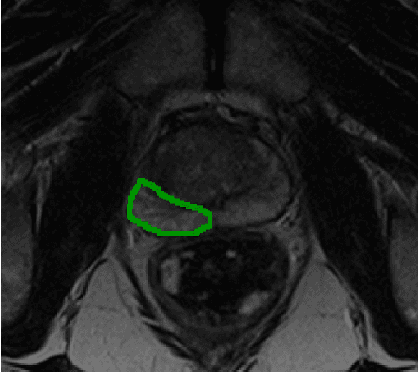 Prostate cancer progression.