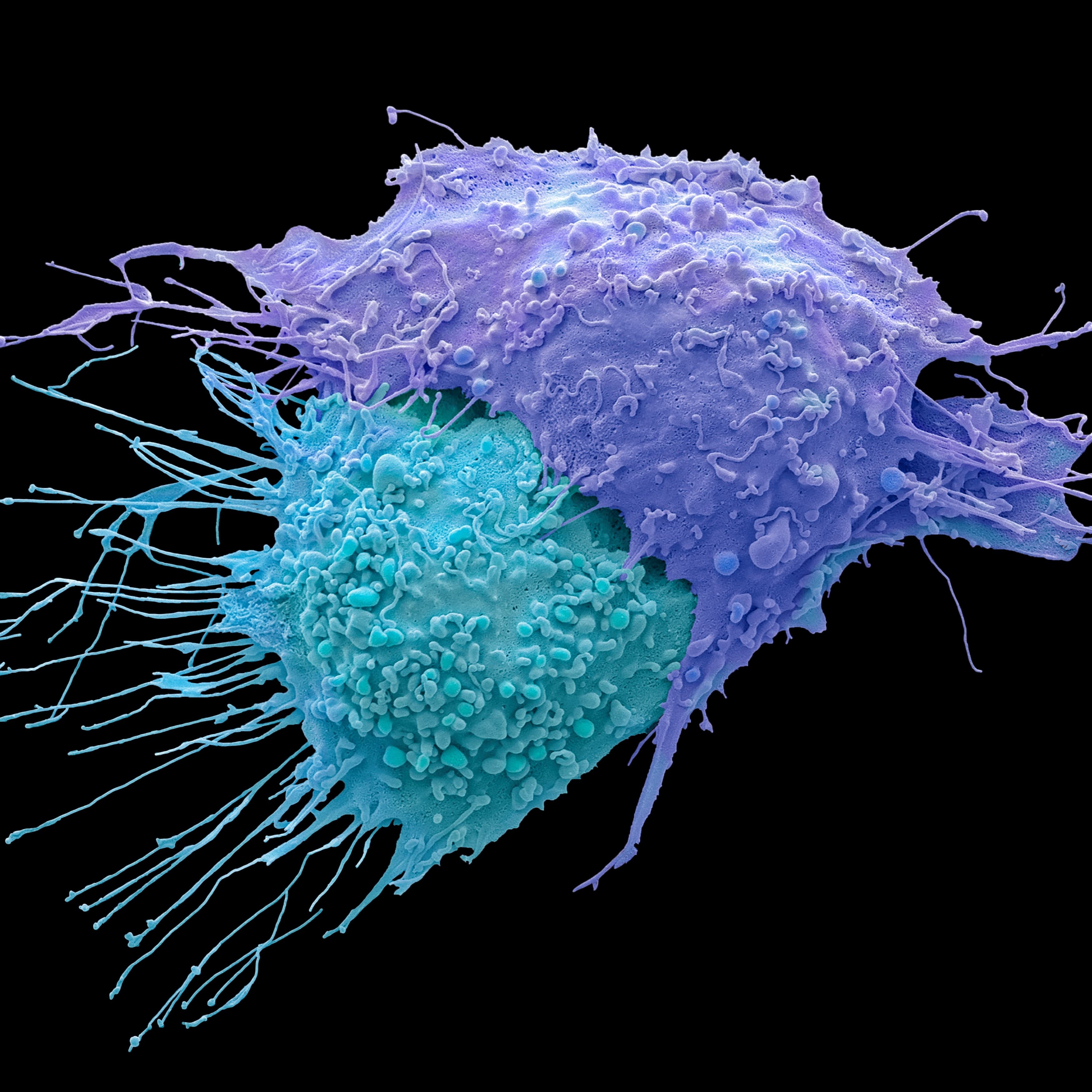 Ovarian cancer cells.