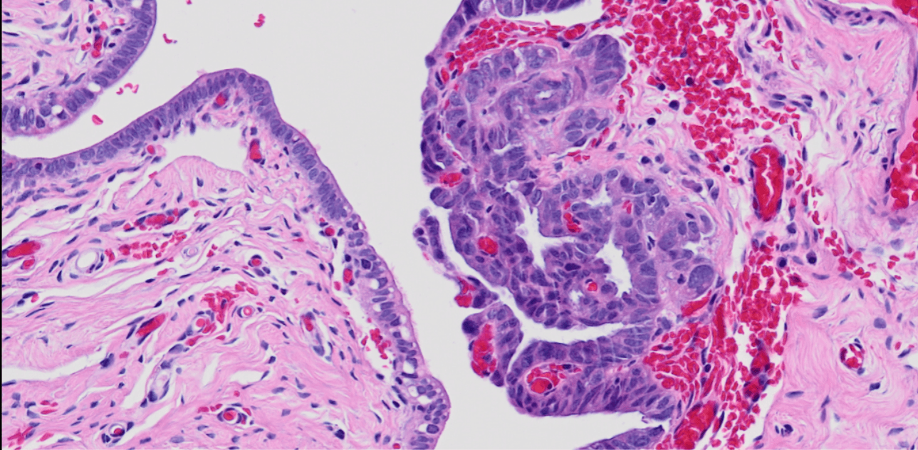 Early markers for ovarian cancer detection.