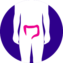 Bowel Cancer