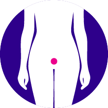 Cervical Cancer