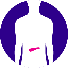 Pancreatic Cancer