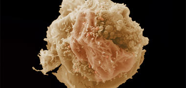 A microscope image of a breast cancer cell