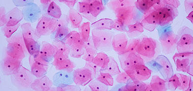 Cervical cells seen under a microscope