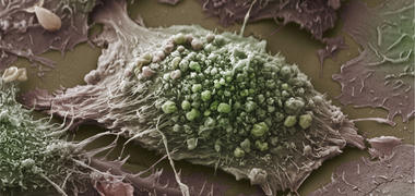 A microscope image of a lung cancer cell