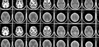 Brain MRI scans