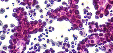 Non small cell lung cancer cells seen under the microscope