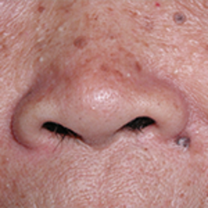 Photo of a face with skin lesions
