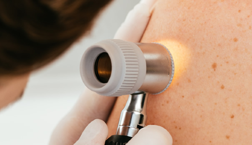 mole check up