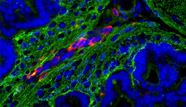Microscope image of a prostate tumour