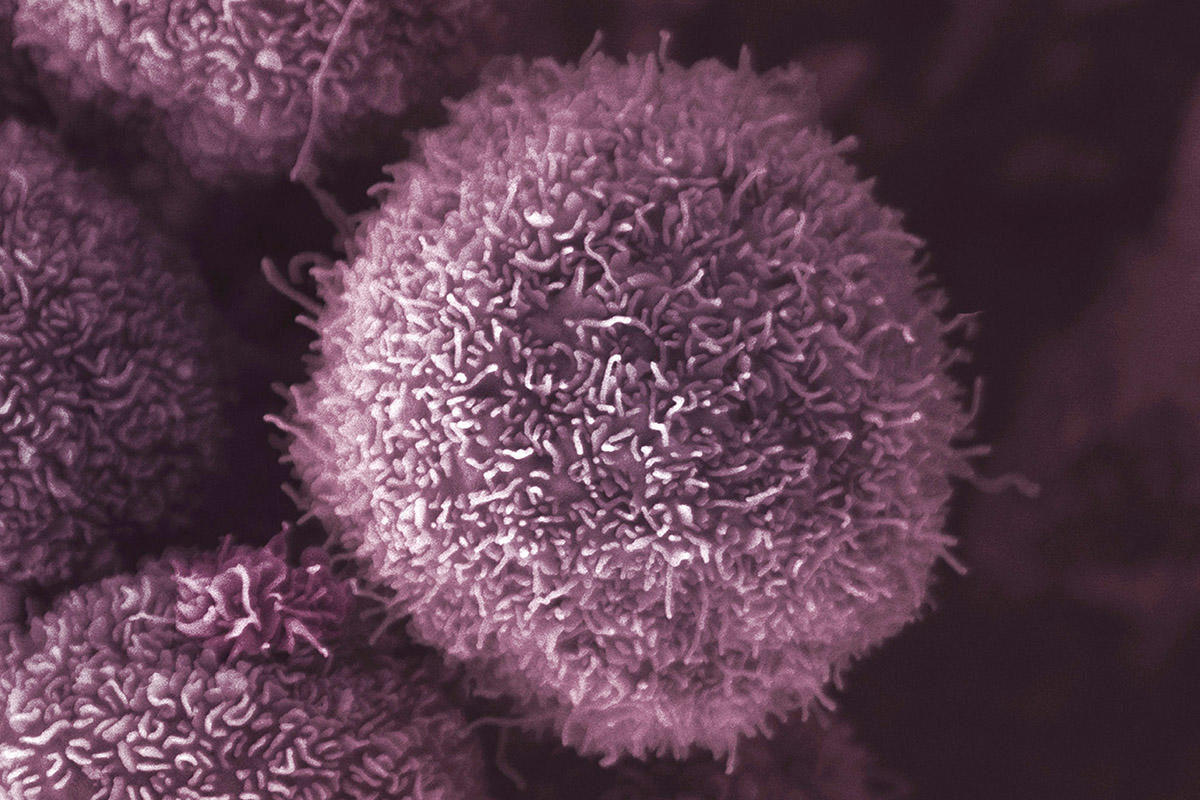 Pancreatic cancer cells - CRUK London Research Institute, Electron Microscopy Unit Pancreatic cancer cells - CRUK London Research Institute, Electron Microscopy Unit