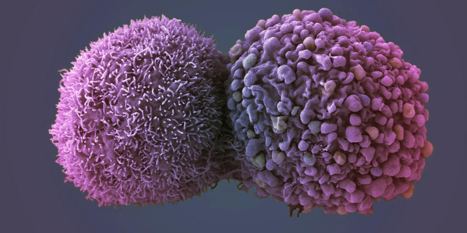 Lung cancer cells - LRI EM Unit Lung cancer cells - LRI EM Unit