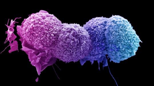 Cancer cell image taken by the LRI EM Unit