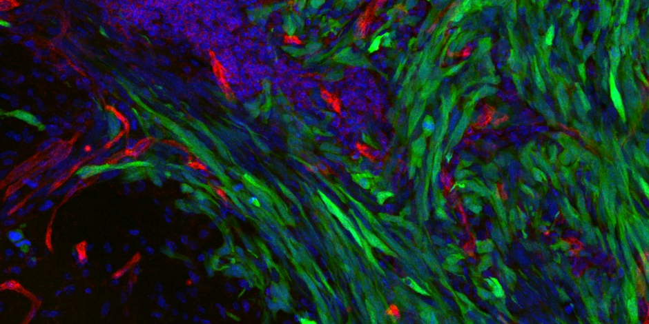 GFP-labelled tumour cells invading normal brain along blood vessels GFP-labelled tumour cells invading normal brain along blood vessels