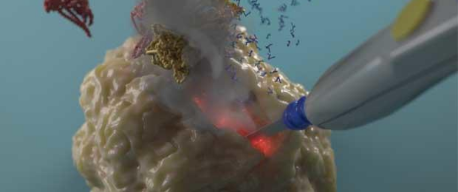 iKnife being used to examine tumour