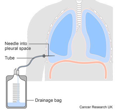 SIMPLE- Diagram