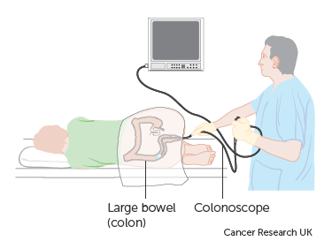 INWARD study sigmoidoscopy diagram