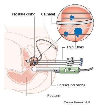 SpectraCure P18 Diagram
