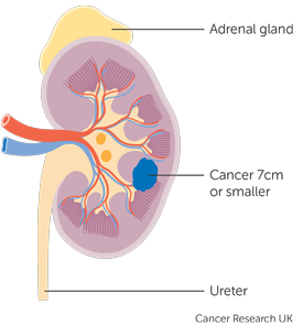 PARTIAL study - diagram showing stage 1 kidney cancer