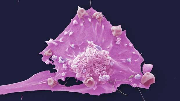 Breast cancer cell Breast cancer cell