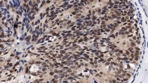 Human breast cancer cells.