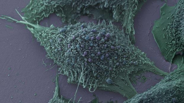 Lung cancer cell