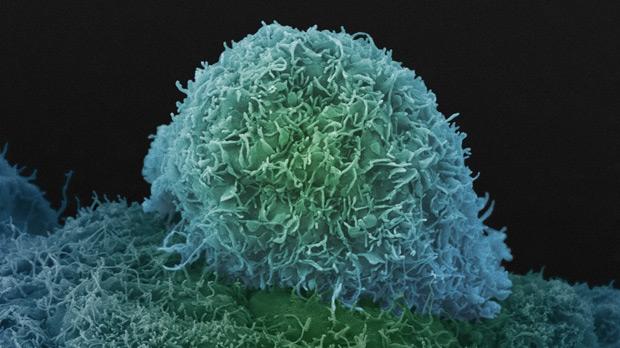 Prostate cancer cells Prostate cancer cells