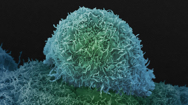 Prostate cancer cell.