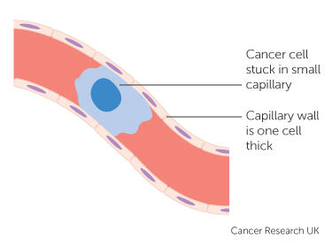 a cancer cell stuck in a small blood vessel capillary