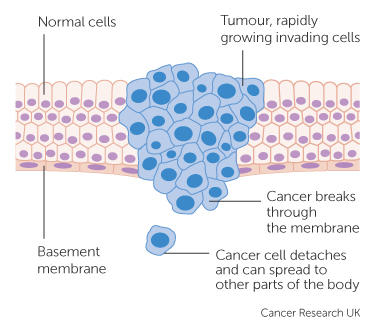 a malignant tumour