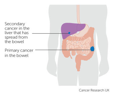 a primary and secondary cancer