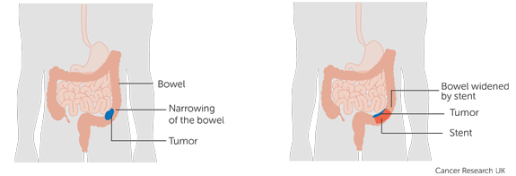 CREST 2 trial stent diagram