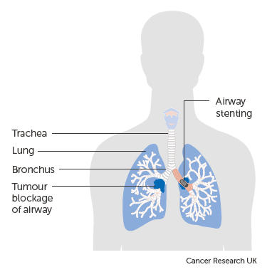 Diagram-showing-an-airway-stent
