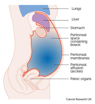Diagram showing fluid in the abdomen