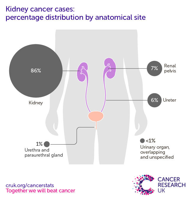 Infographic showing the most common specific location for kidney cancers in the UK is the kidney itself 