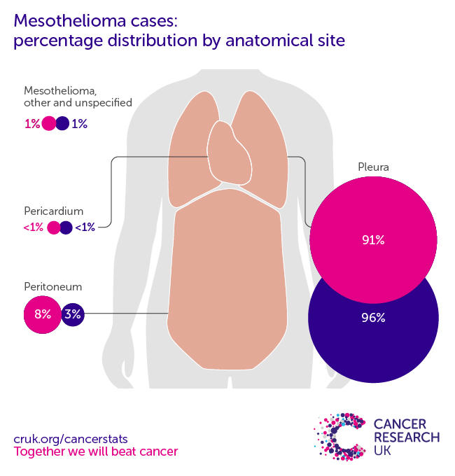Infographic showing the most common specific location for mesotheliomas in the UK is the pleura